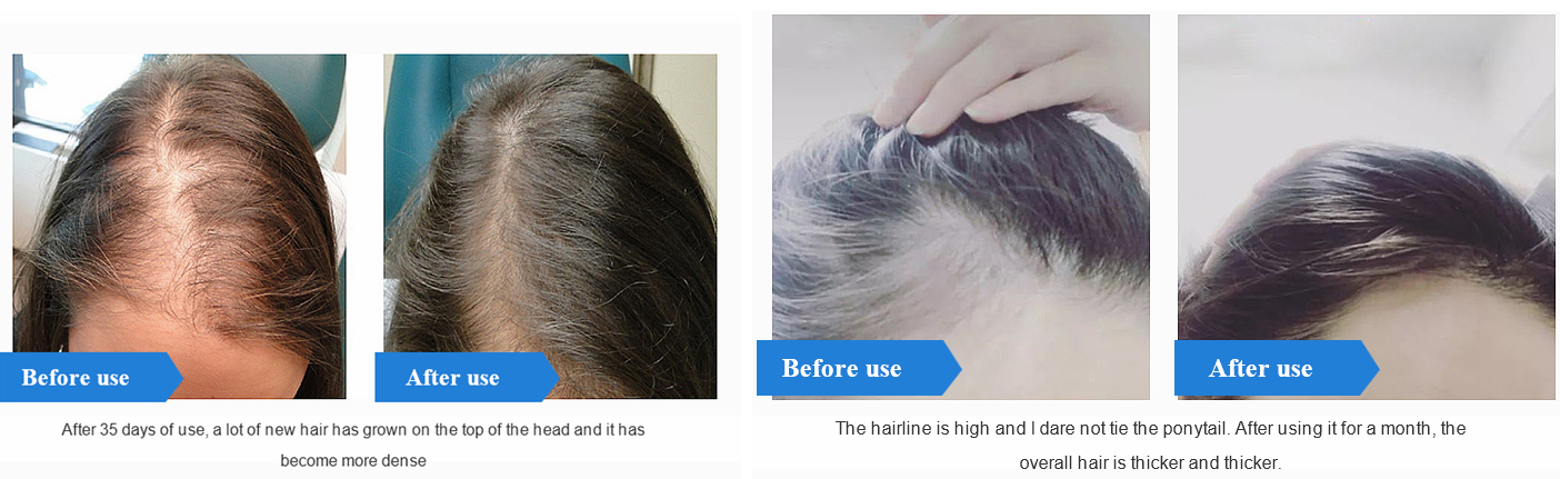 Minoxidil 5%