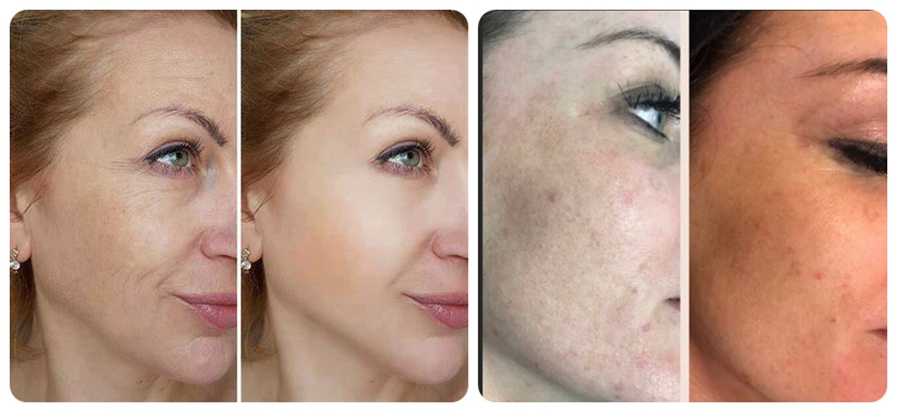 Sponge microneedle